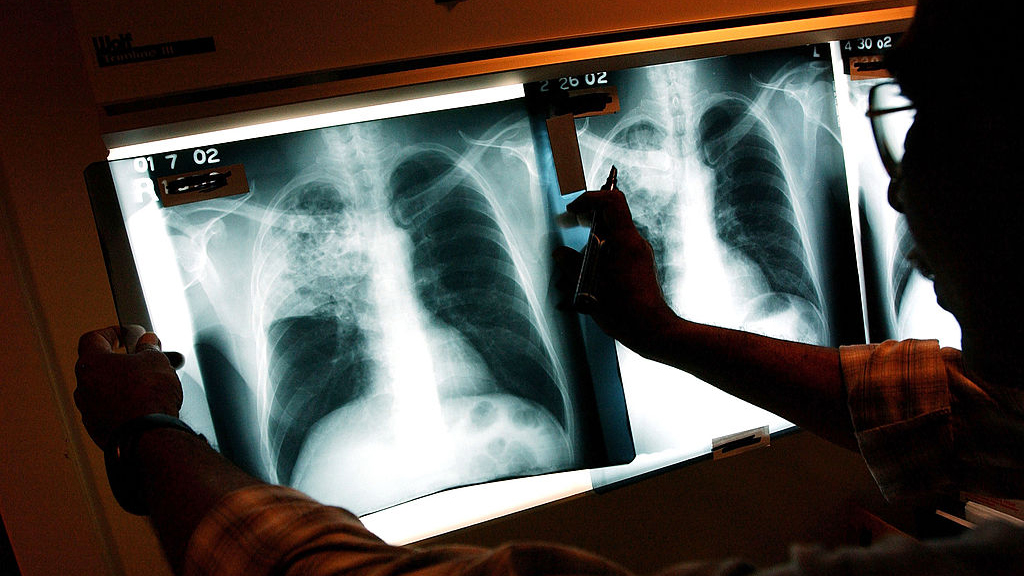 2 active tuberculosis cases traced to San Francisco strip club — KTVU FOX 2 Bay Area, Walnut Creek Health news